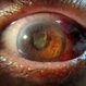 Endophthalmitis one day after tap and injection.