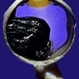 Choroidal Melanoma