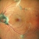 TRACTIONAL RETINAL DETACHMENT TRACTIONAL RETINAL DETACHMENT
