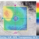 Choroidal Hemangioma