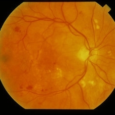 Heme Exudate Ischemia From Multiple Myeloma - Retina Image Bank