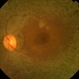 Retinitis Pigmentosa Retinitis Pigmentosa