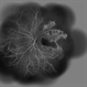 Idiopathic Occlusive Retinal Vasculitis (Late Stage) Idiopathic Occlusive Retinal Vasculitis (Late Stage)