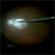 Staining-the-vitreous Staining-the-vitreous