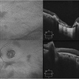 North Carolina Macular Dystrophy Grade 3 North Carolina Macular Dystrophy Grade 3