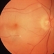 Embolic Central Retinal Artery Occlusion
