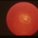 Metallic Intraocular Foreign Body Embedded in Retina Metallic Intraocular Foreign Body Embedded in Retina
