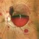 SUB HYALOID HEMORRHAGE