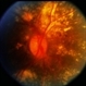 CNVM / Cholesterolemia