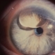 Silicone Oil in Anterior Chamber Silicone Oil in Anterior Chamber