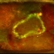 Retinal Detachment with PVR (s/ SPR, PPV, MPV, 360 Retinectomy, PFO, PI, FAx, SO) Retinal Detachment with PVR (s/ SPR, PPV, MPV, 360 Retinectomy, PFO, PI, FAx, SO)
