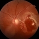 Traumatic Macular Hole Traumatic Macular Hole