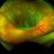 Retinal Detachment with Multiple Retinal Tears Retinal Detachment with Multiple Retinal Tears