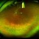 Pigmentary Retinal Dystrophy Pigmentary Retinal Dystrophy