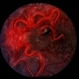 Wyburn-Mason Syndrome