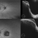 North Carolina Macular Dystrophy Grade 3 North Carolina Macular Dystrophy Grade 3