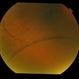 Bilateral Senile Retinoschisis