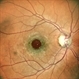 Full Thickness Macular Hole Full Thickness Macular Hole