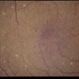 Tamoxifen Tamoxifen