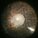 Spontaneously Dropped Lens in a Congenital Rubella Syndrome Spontaneously Dropped Lens in a Congenital Rubella Syndrome