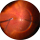 Scleral Fixated Intraocular Lens Scleral Fixated Intraocular Lens
