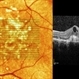 Punctate Inner Choroidopathy Complicated with CNV Punctate Inner Choroidopathy Complicated with CNV