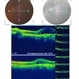 Resistant Wet AMD Responsive on Aflibercept