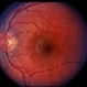 Solar Retinopathy / Familial Solar Retinopathy / Familial