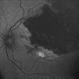 Branch Retinal Vein Occlusion  with Macular Edema Branch Retinal Vein Occlusion  with Macular Edema