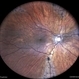 Pigmented Paravenous Retinochoroidal Atrophy Pigmented Paravenous Retinochoroidal Atrophy