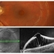 Optic Disc Pit with Maculopathy Optic Disc Pit with Maculopathy