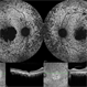 Stargardt's Disease (Extensive)