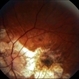 Myopic Degeneration, Macular Hemorrhage Myopic Degeneration, Macular Hemorrhage