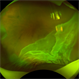 Total RRD with GRT with Choroidal Detachment Total RRD with GRT with Choroidal Detachment
