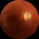 Pale PNO Due to Idiopatic Intracranial Hypertension Pale PNO Due to Idiopatic Intracranial Hypertension