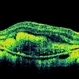 Myopia Associated CNVM Myopia Associated CNVM