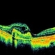 Myopia Associated CNVM Myopia Associated CNVM