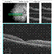 One Week Post Blunt Trauma Macular HD OCT One Week Post Blunt Trauma Macular HD OCT