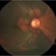 Broad Subretinal Hemorrhage Broad Subretinal Hemorrhage