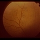 Congenital Hypertrophy of the Retinal Pigment (CHRPE) Congenital Hypertrophy of the Retinal Pigment (CHRPE)
