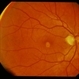 Adult Foveomacular Dystrophy / Pattern Adult Foveomacular Dystrophy / Pattern