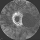 Macular Coloboma and Pigmentary Retinopathy Macular Coloboma and Pigmentary Retinopathy