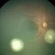 Multifocal Retinoblastoma Multifocal Retinoblastoma