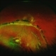 Chronic Inferior Retinal Detachment Chronic Inferior Retinal Detachment