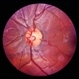 Preretinal Vascular Loop Preretinal Vascular Loop