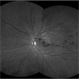 Branch retinal vein occlusion - Colour & Red free image - ring shaped collaterals