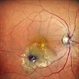 Retinal Artery Macroaneurysm With Macular Edema