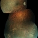Dislocated IOL in Vitreous Cavity Dislocated IOL in Vitreous Cavity