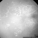 Retinopathy of Prematurity Under-Treated with Laser