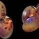 Acute Myeloid Leukemia Acute Myeloid Leukemia
